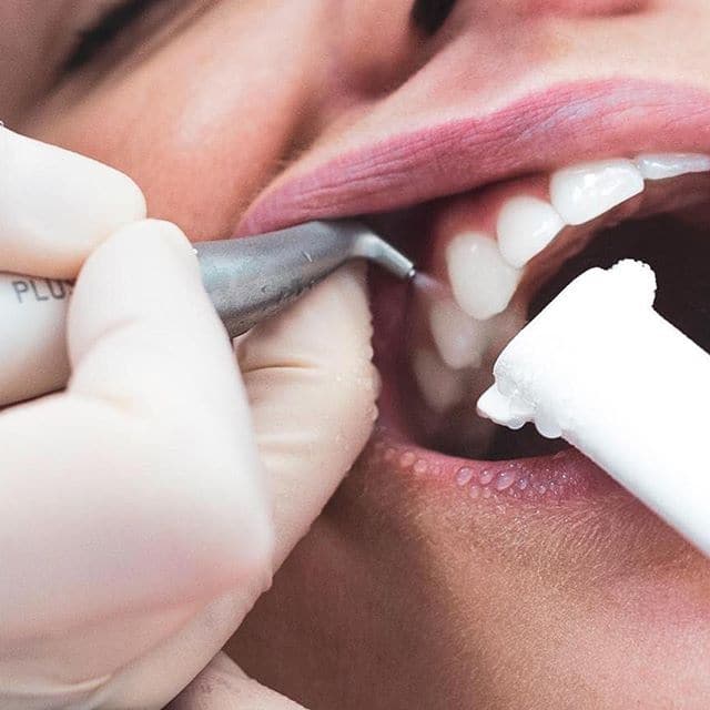 Professionelle Zahnreinigung